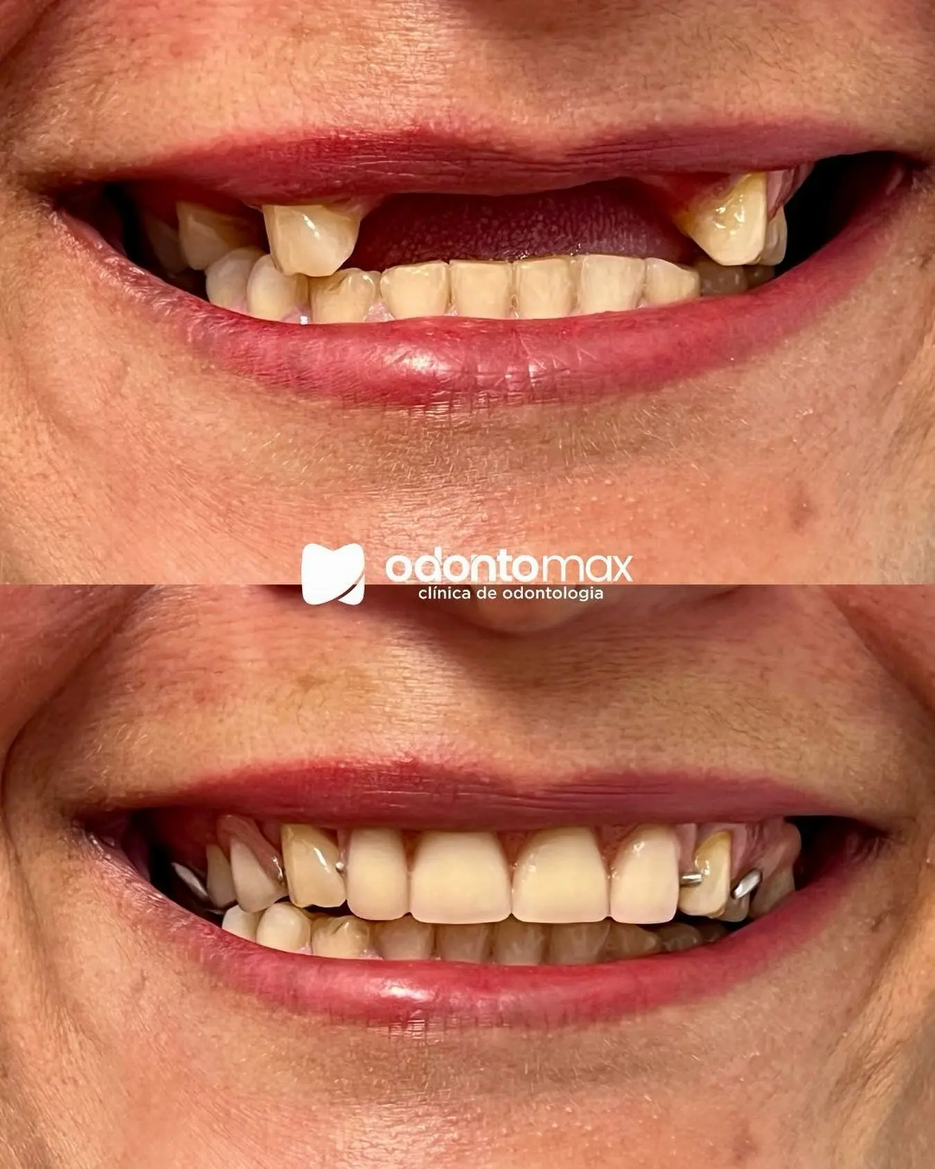 Correção de Mordida e Apinhamento — Antes e Depois na Odontomax