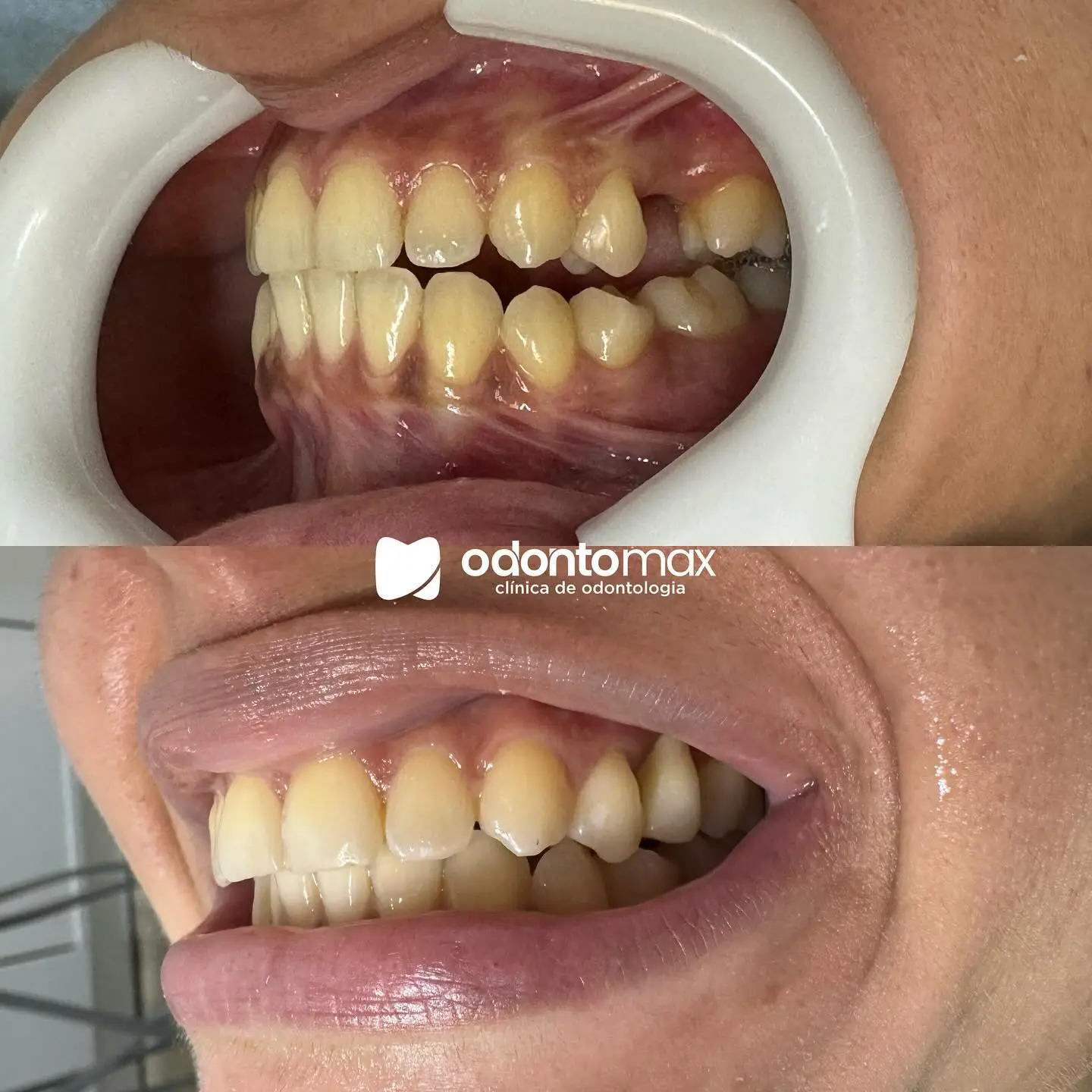 Facetas Diretas nos Incisivos — Antes e Depois na Odontomax