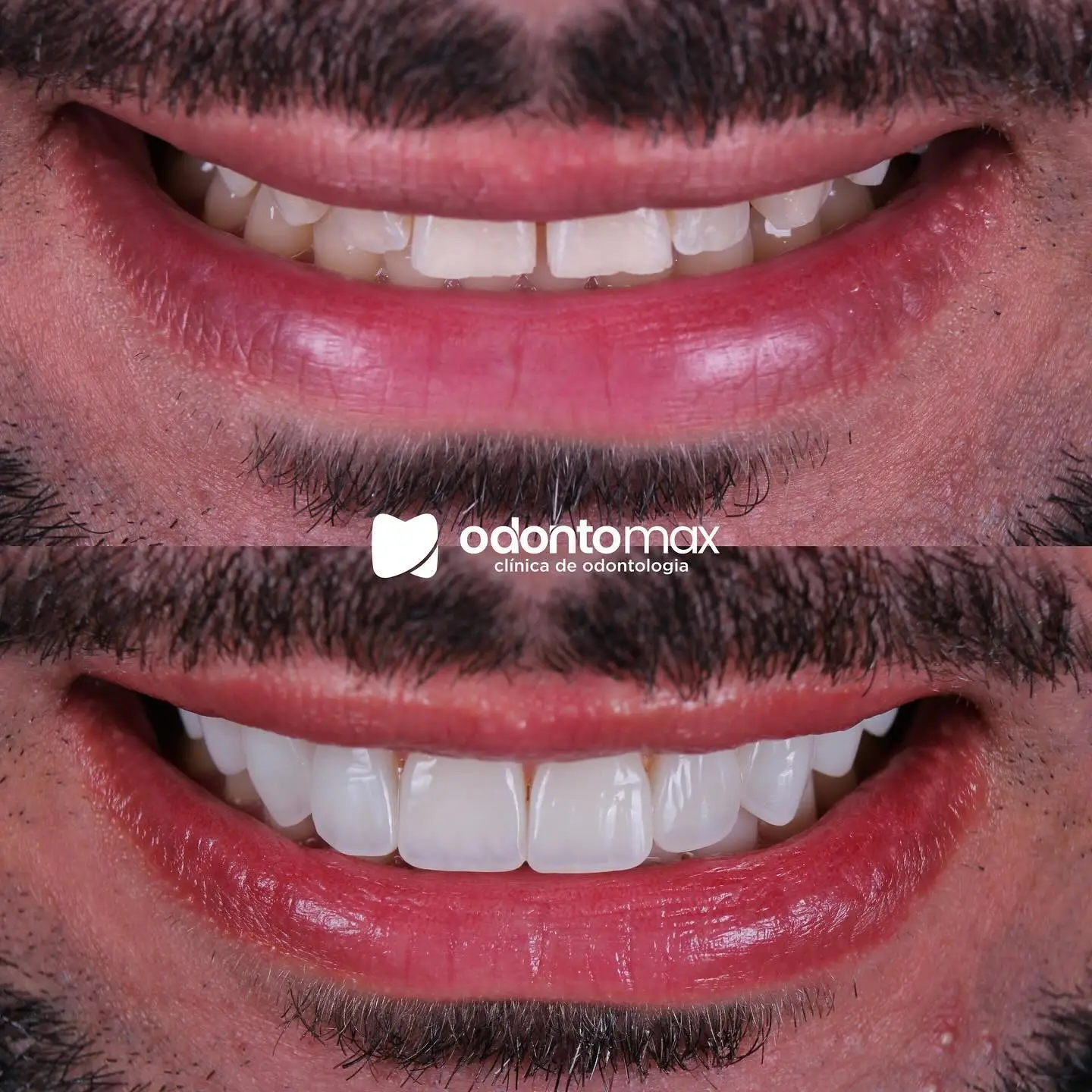 Reconstrução Estética Anterior — Antes e Depois na Odontomax