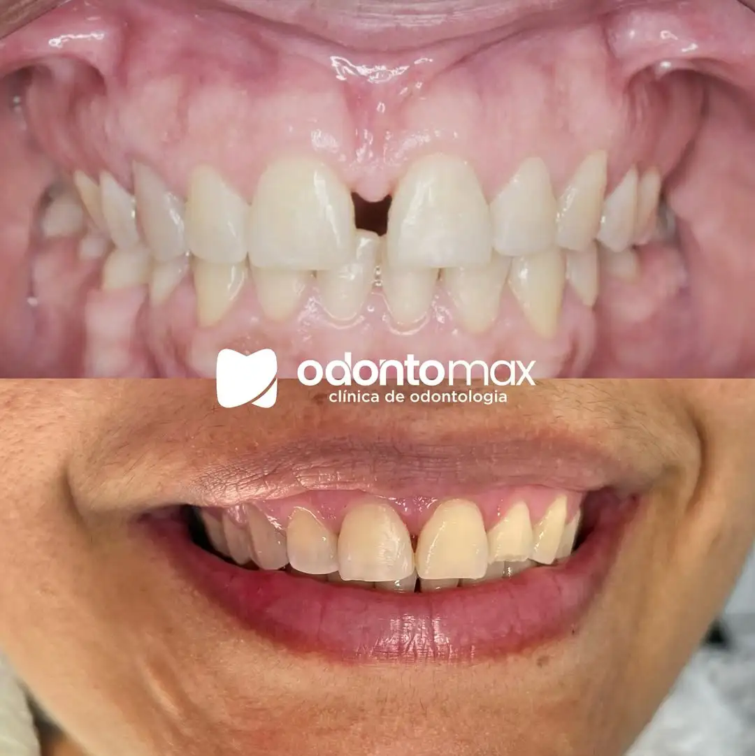 Alinhamento Dental Superior e Inferior — Antes e Depois na Odontomax