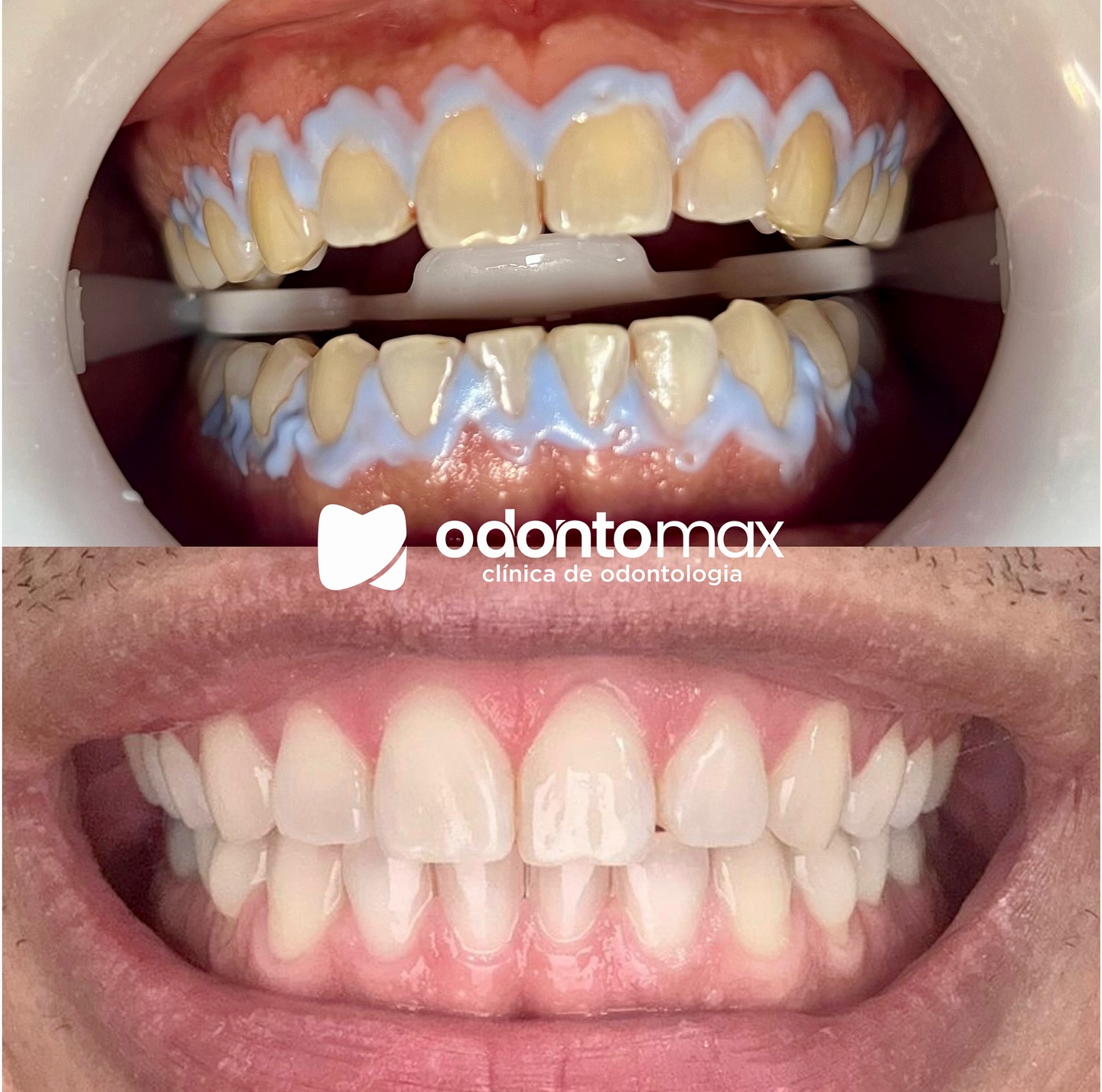 Transformação Estética do Sorriso — Antes e Depois na Odontomax